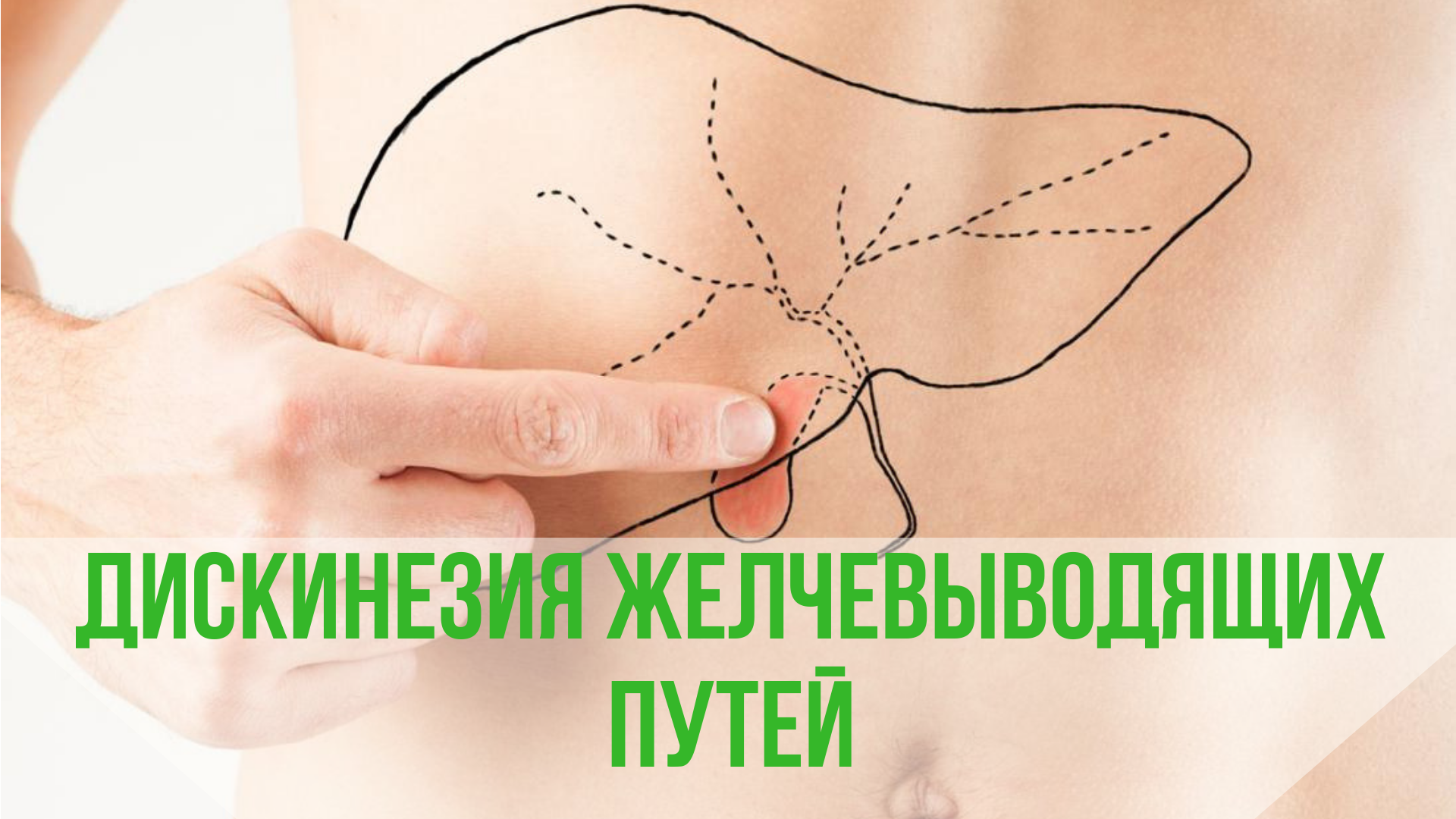 Дискинезия желчевыводящих путей