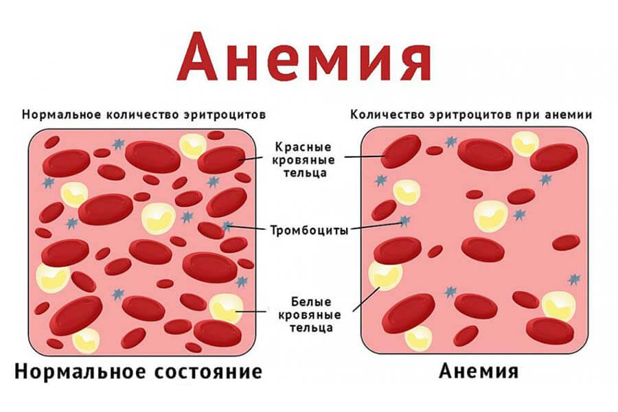 anemiya-min Анемия. Причины и эффективное лечение