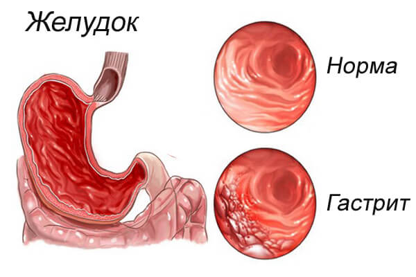 gastrit Гастрит