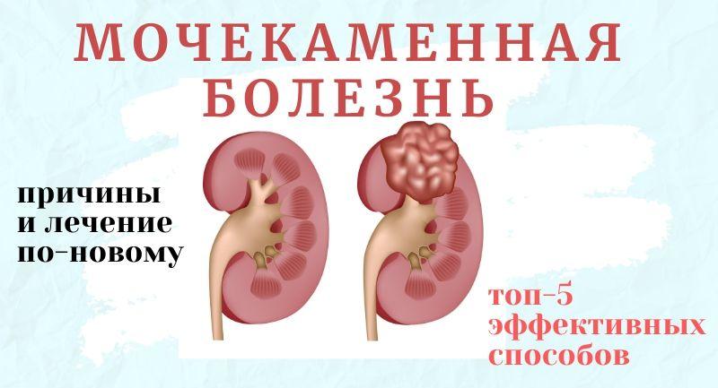 Блог Мочекаменная болезнь. Лечим по-новому, топ 5 способов!